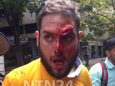 Chavistas golpean a botellazos en la cabeza al diputado opositor Juan Requesens