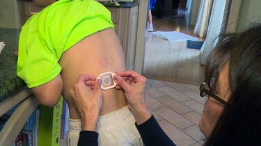 Inventan parche para que personas alérgicas al maní puedan comerlo sin riesgos