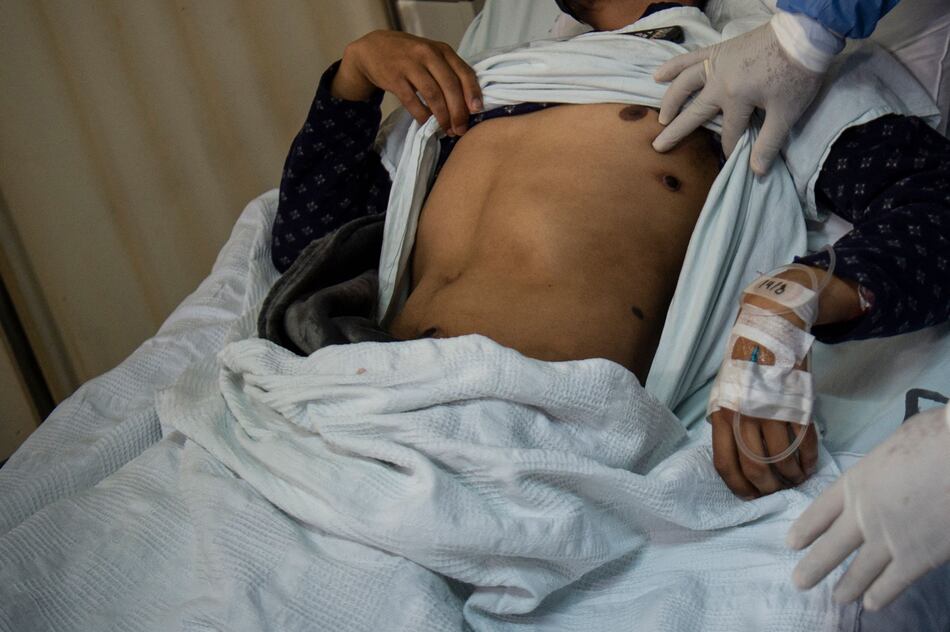 Panamá, aún sin transmisión comunitaria de la viruela símica