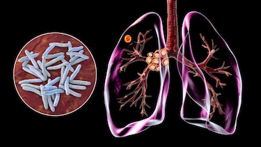 Por qué la tuberculosis sigue matando a tanta gente si hay una cura