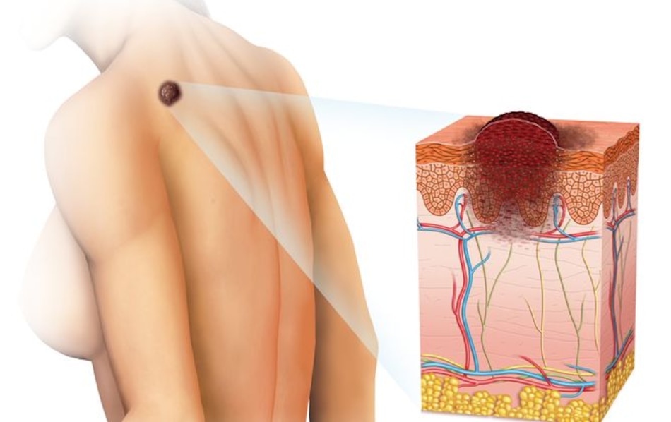 Tener más de 11 lunares en el brazo derecho indica riesgo de melanoma