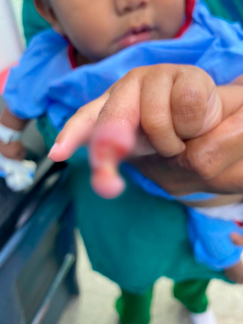 Hospital del Niño alerta por el uso de pirotecnia y pide extremar la prevención