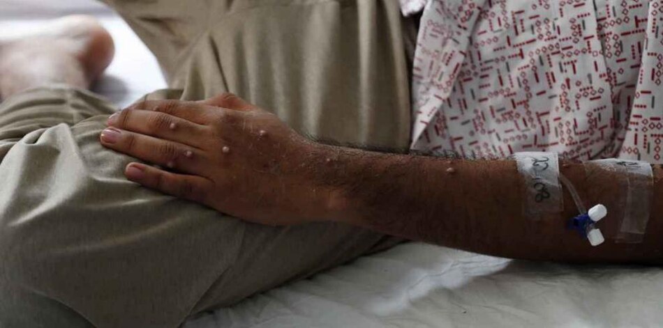 Nueva variante de la viruela del mono no ha llegado a Panamá; el país acumula 241 casos de otra cepa