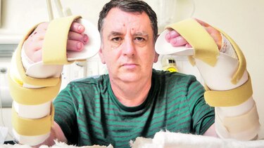 Paciente de trasplante de manos se recupera