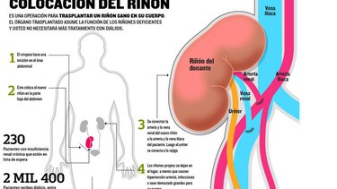 Más pacientes en hemodiálisis que en lista para trasplante