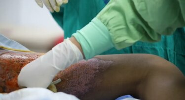 614 niños afectados por quemaduras en solo seis meses: llaman a crear cultura de prevención en Panamá