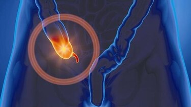 Enfermedad hemorroidal, el tabú de una inflamación