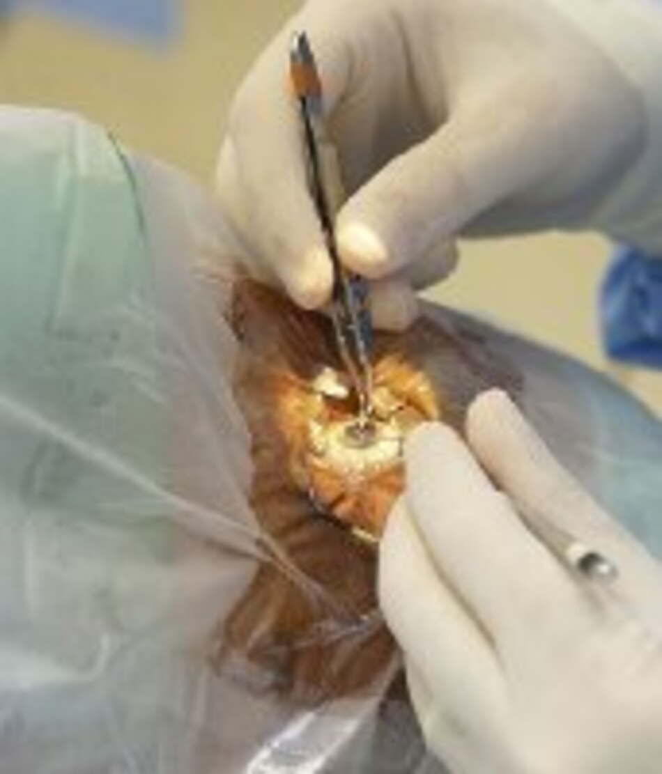 Ceguera por cataratas