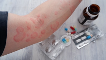 Lupus en Panamá, entre la falta de datos y el acceso desigual a tratamientos