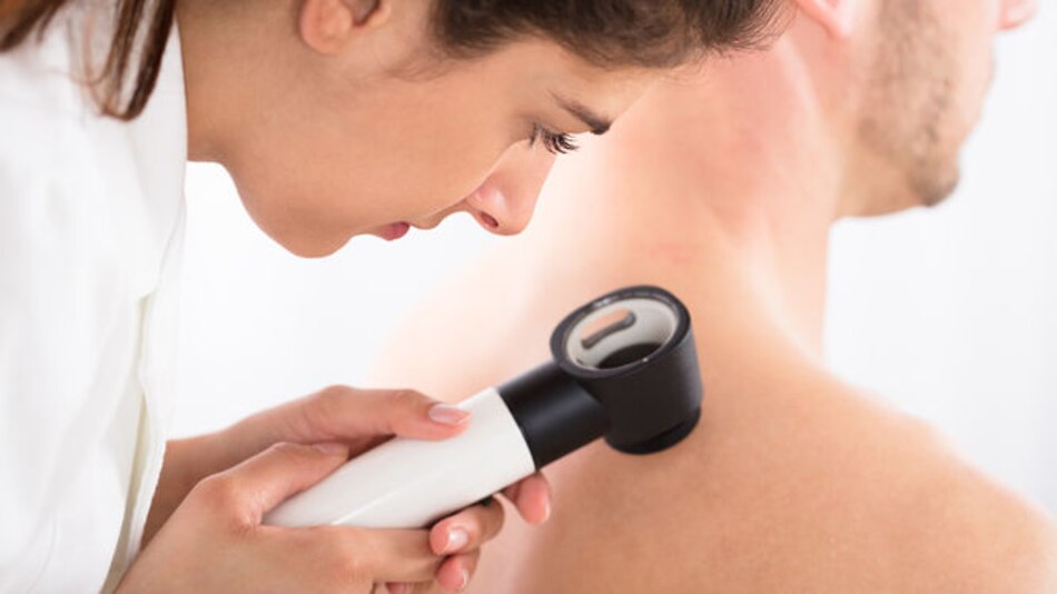El melanoma será el segundo tumor en incidencia global para 2040, según los dermatólogos