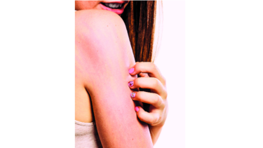 Picazón: ¿un simple síntoma?