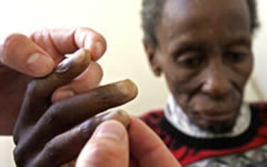 OMS señala esfuerzos por combatir tuberculosis