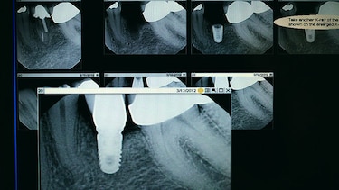 Ingeniería y los biomateriales