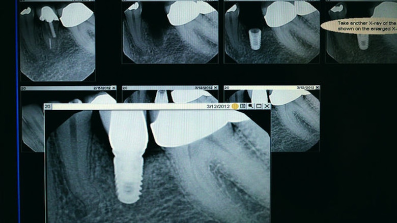 Ingeniería y los biomateriales