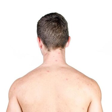 Acné: ¿más común en los deportistas?