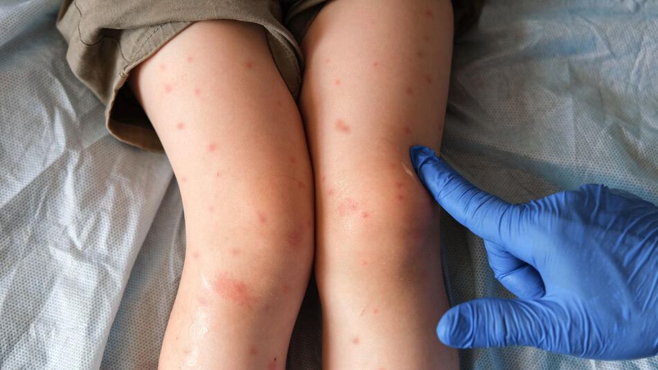 Cómo Canadá se convirtió en el epicentro del sarampión en Norteamérica