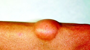 Lipomas, ¿las únicas masas en la piel?