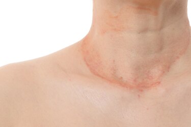 Pacientes con Dermatitis Atópica pueden tener comprometida su salud con brotes intensos hasta 6 meses en el año