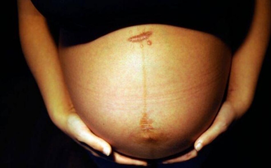 Las mujeres que han tenido una cesárea tienden a tener más problemas para volver a concebir, según estudio