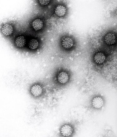 El virus del papiloma humano multiplica el riesgo de sufrir cáncer oral