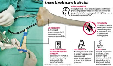Regulan uso de aloinjertos procesados en trasplantes