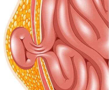 ¿Es ese bulto una hernia?