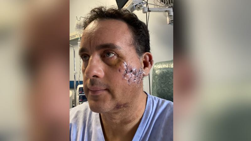 ‘Me perdonó la vida’: el impresionante relato del mexicano que sobrevivió a la mordida de un tiburón en la cabeza