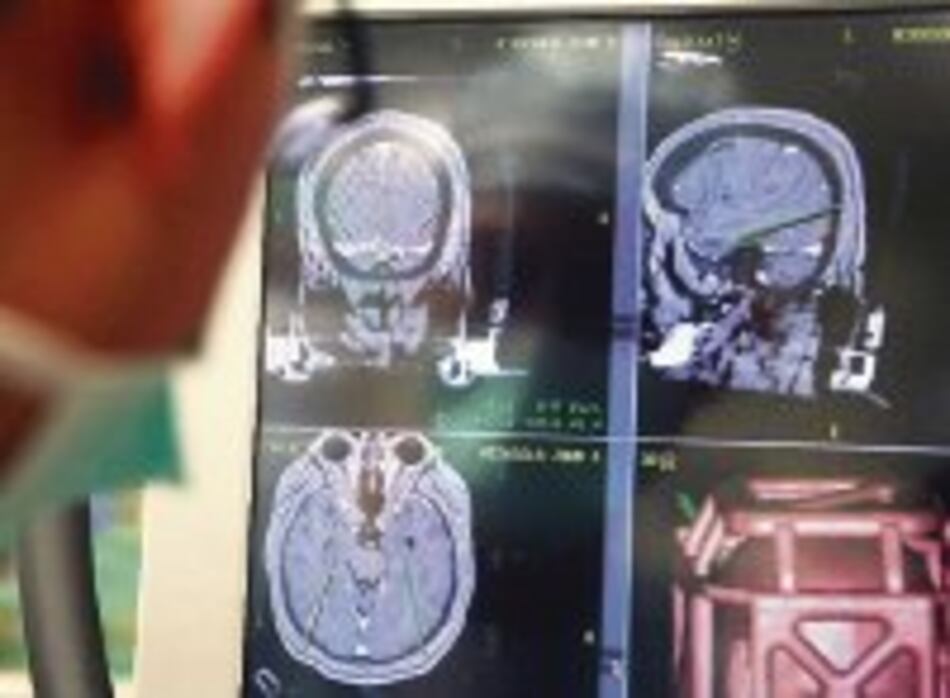 Luces sobre la epilepsia