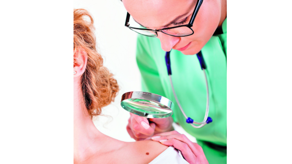 En búsqueda de lunares malignos