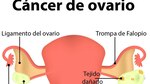 El silencioso cáncer de ovario