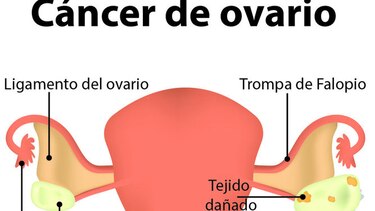 El silencioso cáncer de ovario