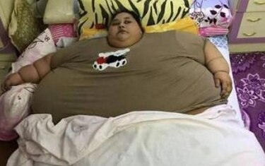 Mujer que pesa 500 kilos será operada en India; no ha salido de su cuarto en 25 años