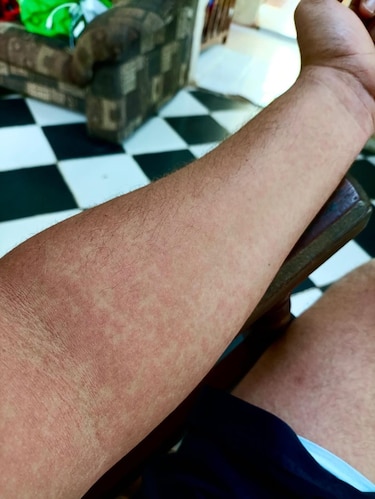 ‘Parece una ciudad de zombis’: la grave epidemia de enfermedades virales transmitidas por mosquitos que enfrenta Cuba en medio de un colapso sanitario