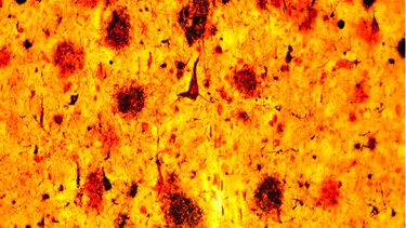 El alzheimer en el contexto de la salud mental