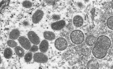 Tres casos en Italia de la viruela del mono en humanos
