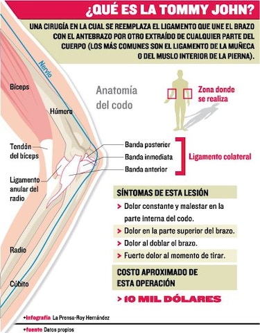 La operación Tommy John