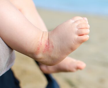 Pacientes con Dermatitis Atópica pueden tener comprometida su salud con brotes intensos hasta 6 meses en el año