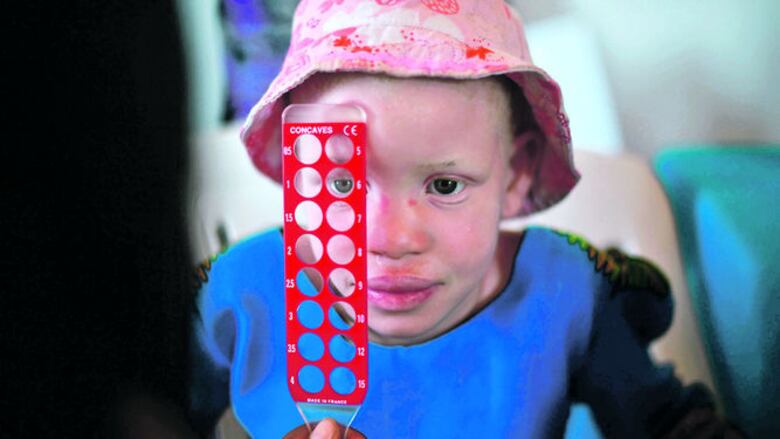 Albinos africanos sufren persecución