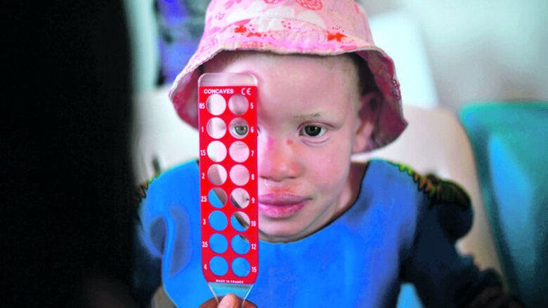 Albinos africanos sufren persecución