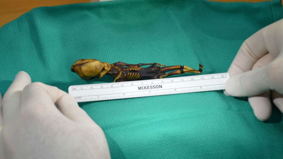 El esqueleto de Atacama era una niña con una enfermedad ósea