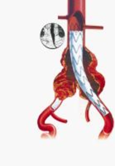 Terapia endovascular