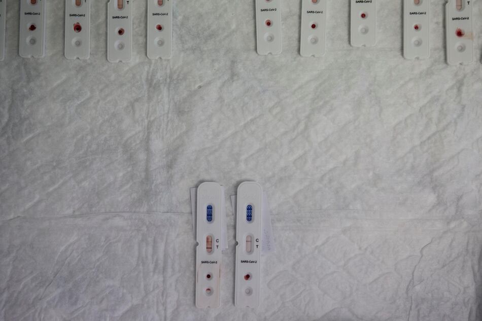 Un estudio revela que la covid-19 deteriora el sistema inmunitario a largo plazo