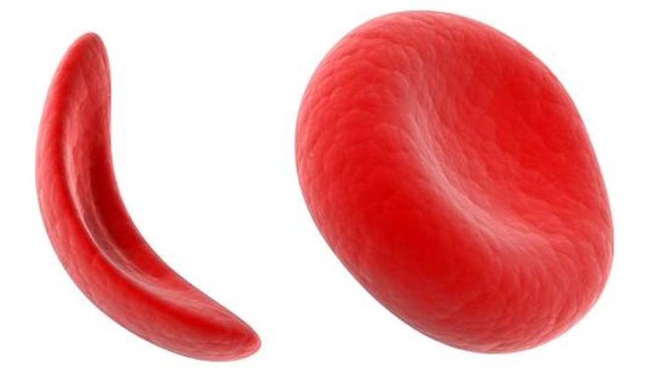 10 mitos de la anemia falciforme