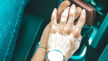 Vitiligo, una enfermedad que no debe causar vergüenza