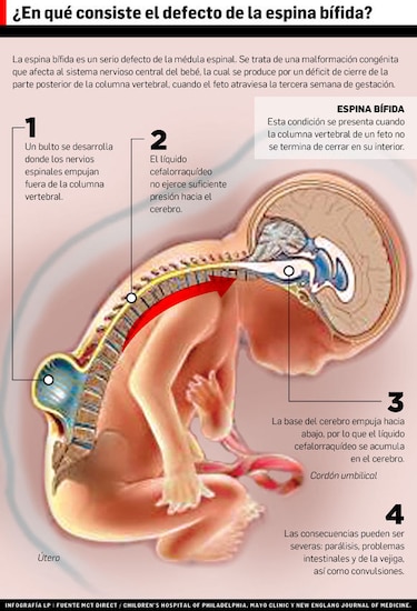 10 mitos de la espina bífida