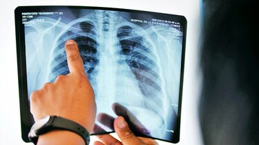 Perú lucha contra tuberculosis difícil de curar