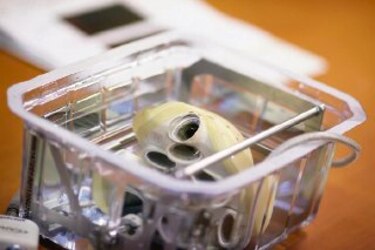 Hito: implantan corazón artificial