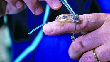 Implante de ojo biónico