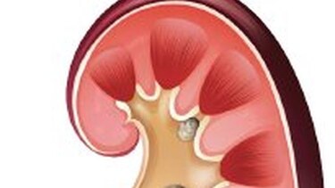 10 mitos de las piedras en los riñones