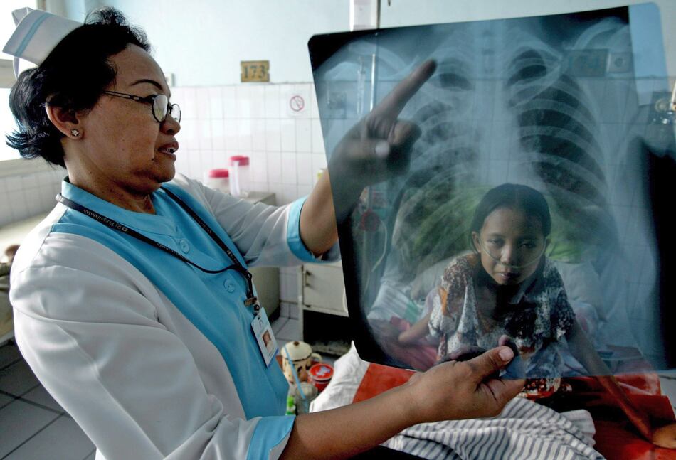 La tuberculosis vuelve a tener auge en el mundo: OMS